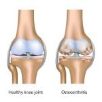 osteoarthritis1
